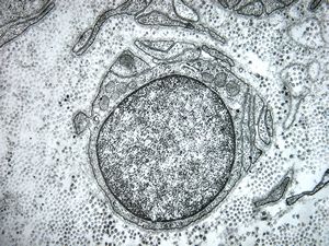 n.suralis - hypertrophic demyelinizing neuropathy n.suralis - hypertrophic demyelinizing neuropathy